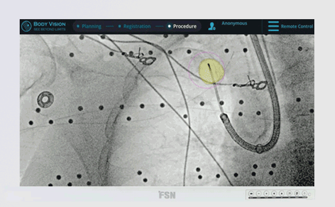 image-guided-bronchoscopy-procedure-for-peripheral-lung-lesions